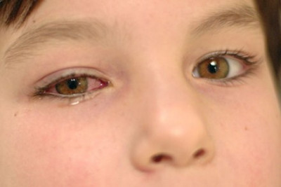 Mẹo chữa đau mắt đỏ nhanh nhất cho bé tại nhà